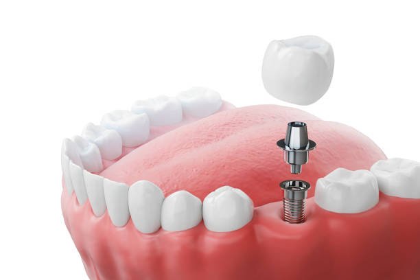 FORT DENTAL IMPLANT VANSATHALIPURAM