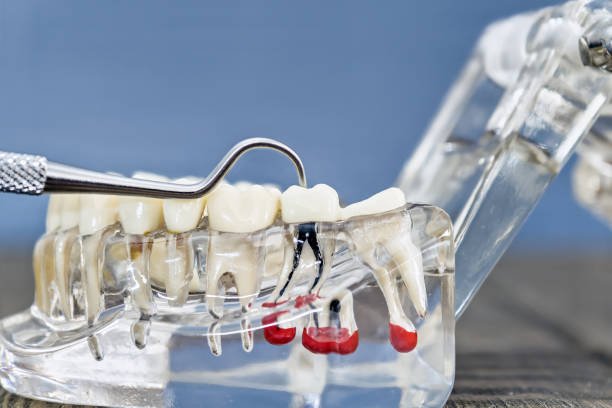 Endodontics Conservative Dentistry