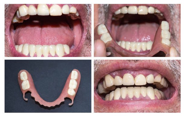 FLEXI DENTURE