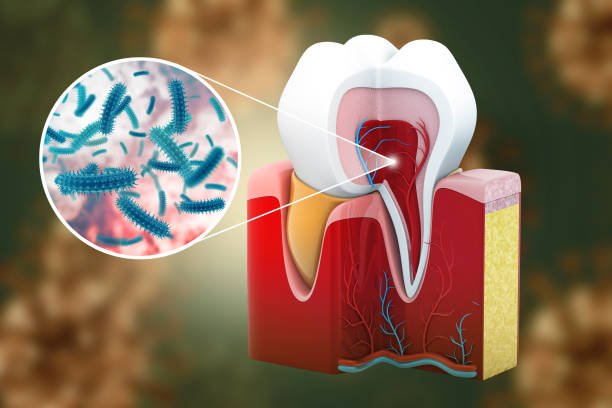GUM DISEASE