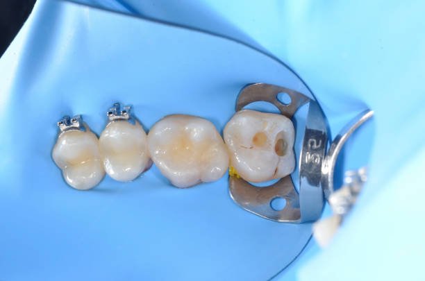 INVISIBLE FILING IN DENTISTRY