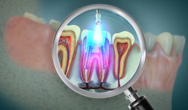 LASER ROOT CANAL TREATMENT