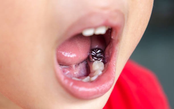 PIT AND FISSURE SEALANT