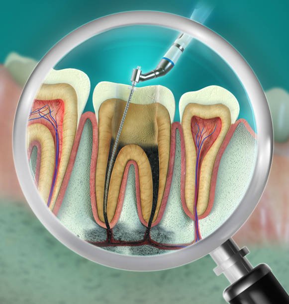 ROOT CANAL TREATMENT