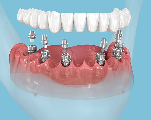 Complete Teeth Replacement